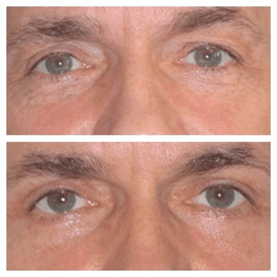 The Role of Eyelid Surgery in Eye Bag Fat Removal