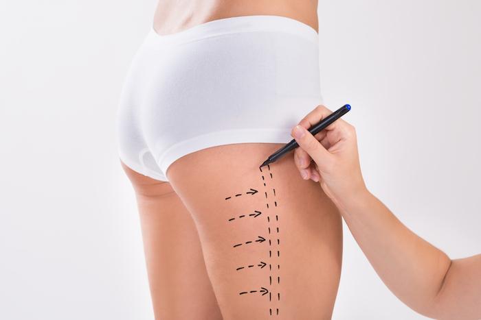 A Guide to Choosing the Right Anesthesia for Your Liposuction Surgery