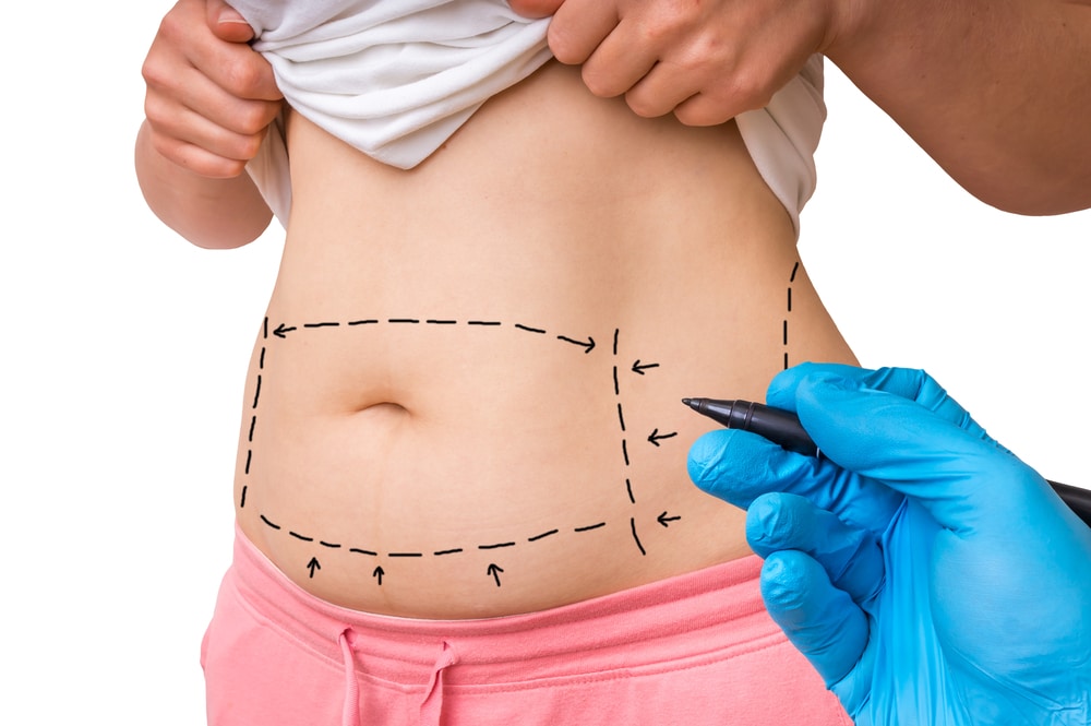 Tummy Tuck and Skin Tightening: What to Expect