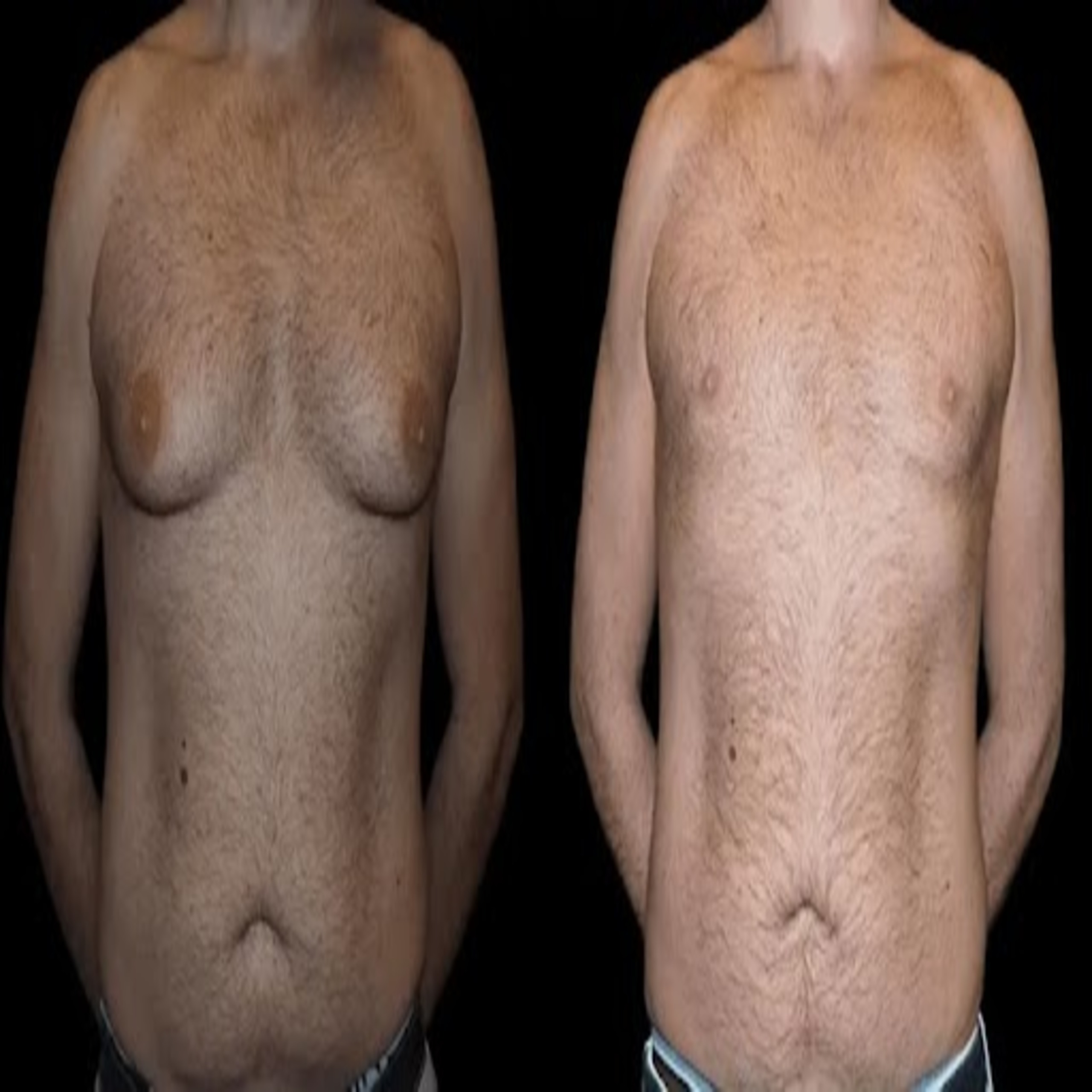 Male Breast Reduction and the Role of Post-Surgery Skincare