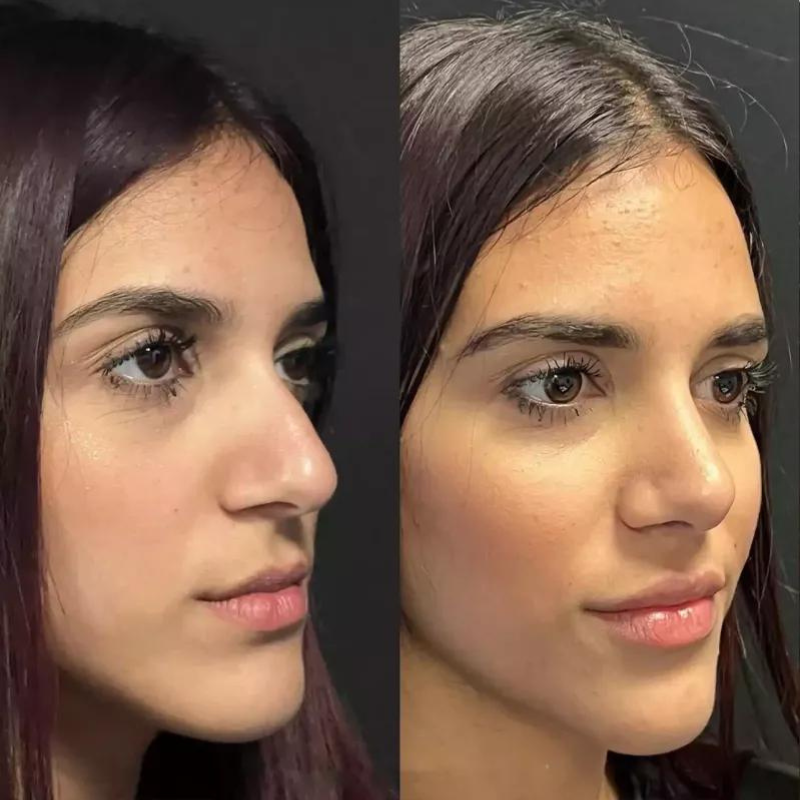 Rhinoplasty and the Impact on Your Smile